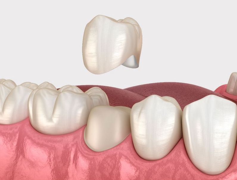 Коронка на зуб: технологии и тенденции в современной стоматологии